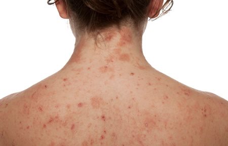 Che può la psoriasi di malattia esser provocata