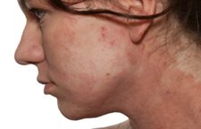 Dal quale la psoriasi su un corpo si sviluppa