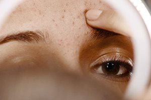 L'acne si presenta in tipi e forme diverse