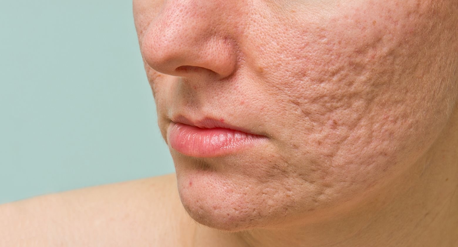 trattamenti viso acne