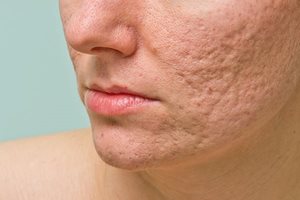 Trattamento e rimozione delle cicatrici acneiche
