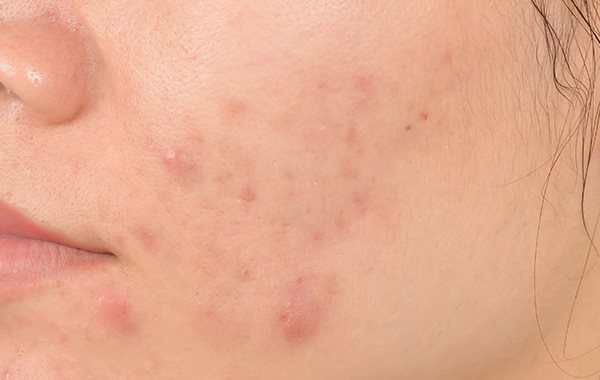 Come Eliminare le Macchie dei Brufoli: 4 RIMEDI IMBATTIBILI!
