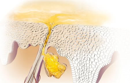 Protuberanze della pelle Protuberanze della pelle