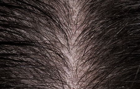 Dermatite sintomi Dermatite sintomi