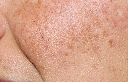 Siccome è dipinto con lentiggini di faccia