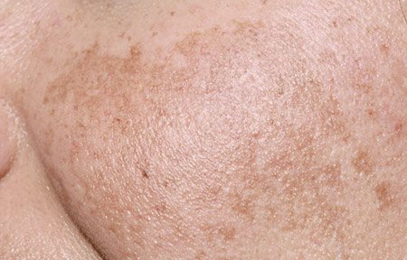 Ingrandimento delle guance di una donna con il melasma