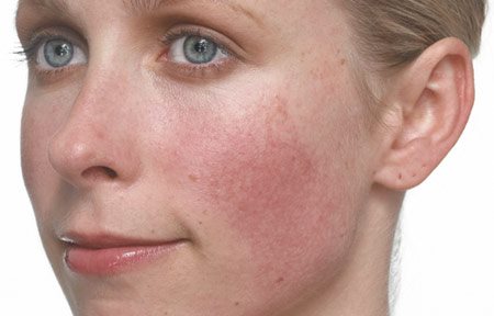 Viso di donna con la pelle bianca e la Rosacea