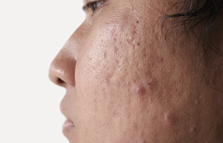 Ingrandimento del viso con l'acne