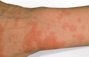Ingrandimento della pelle con una reazione fotoallergica