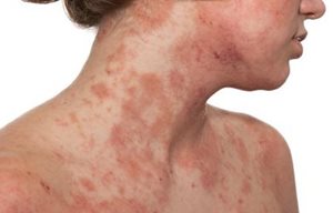 Decolleté di donna e parte inferiore del viso con pelle infetta