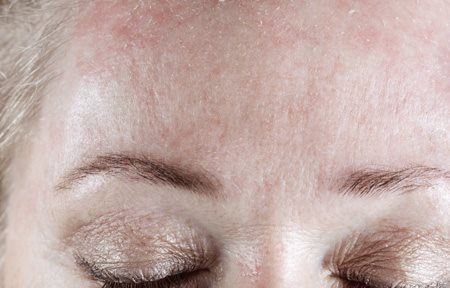 Fronte di donna desquamata